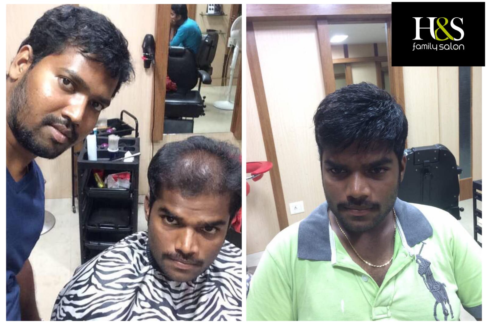 Hair Fixing in chennai