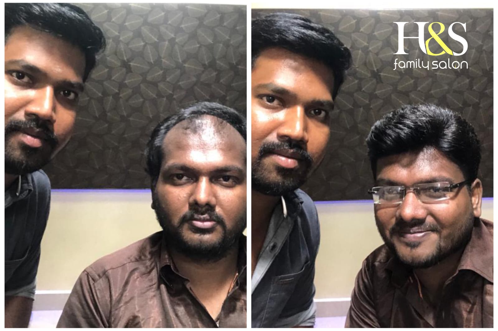 Hair Fixing in chennai