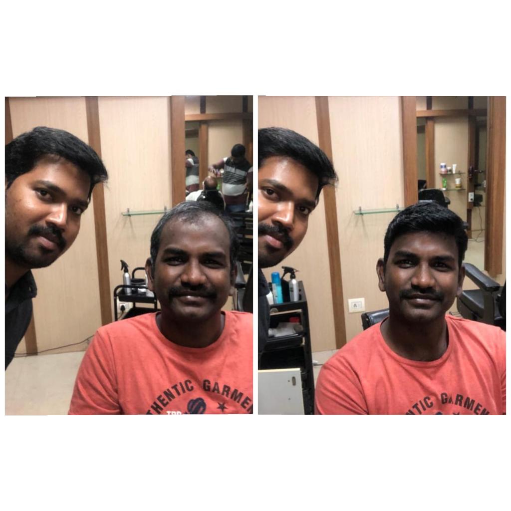 Hair Fixing in chennai