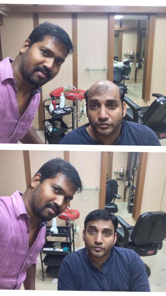 Hair Fixing in chennai