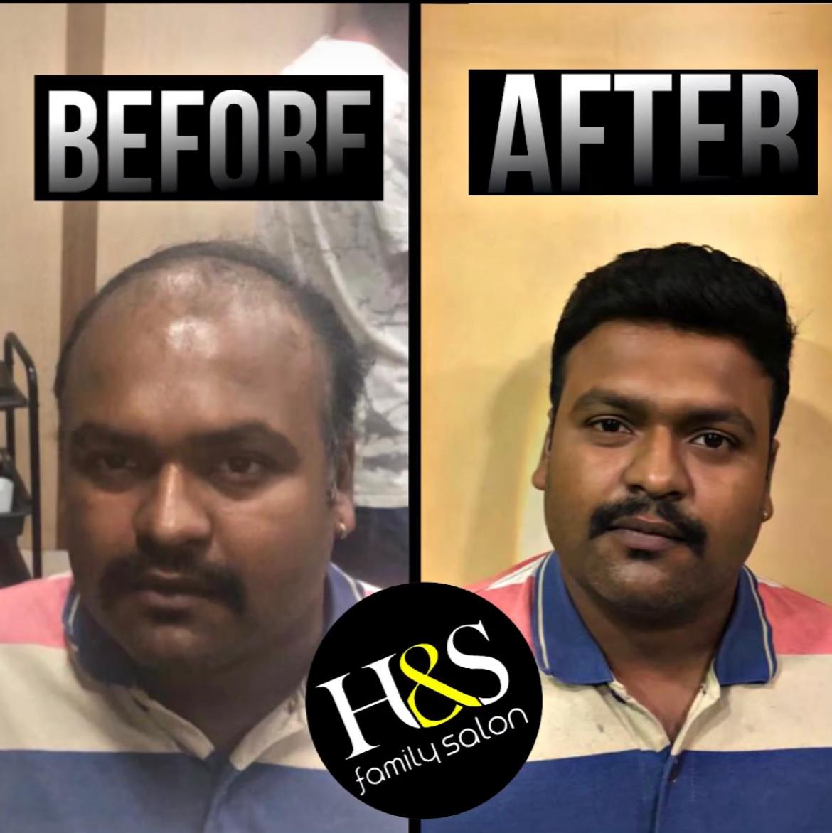 Hair Fixing in chennai