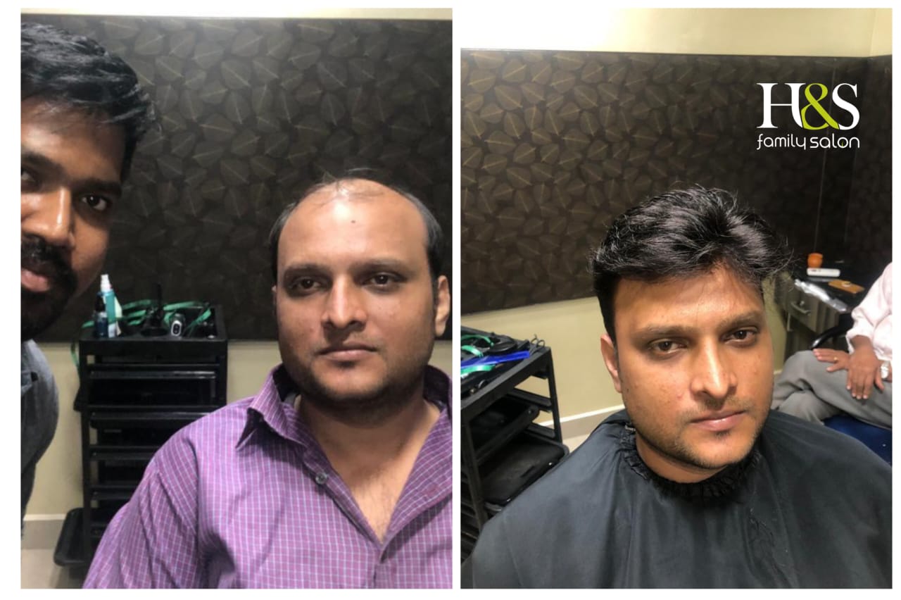 Hair Fixing in chennai