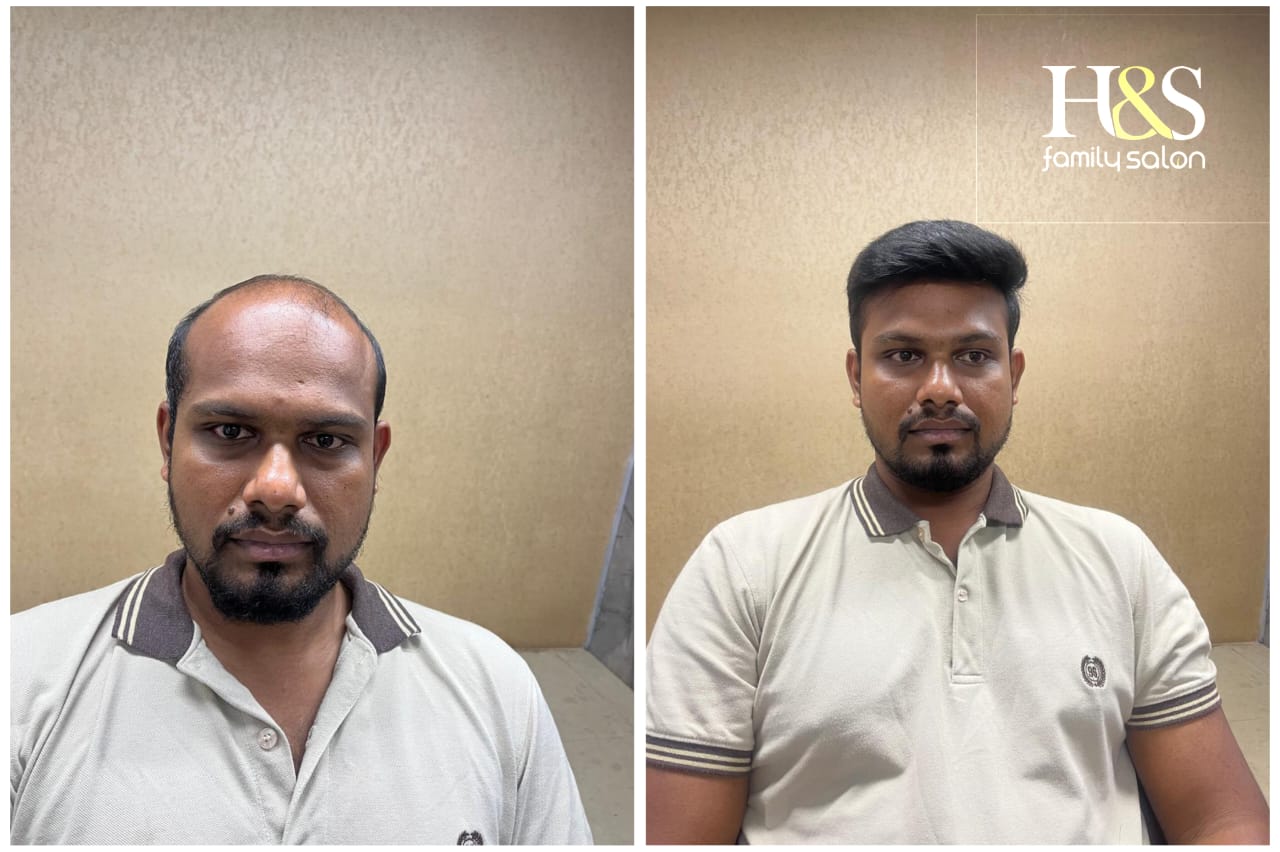 Hair Fixing in chennai