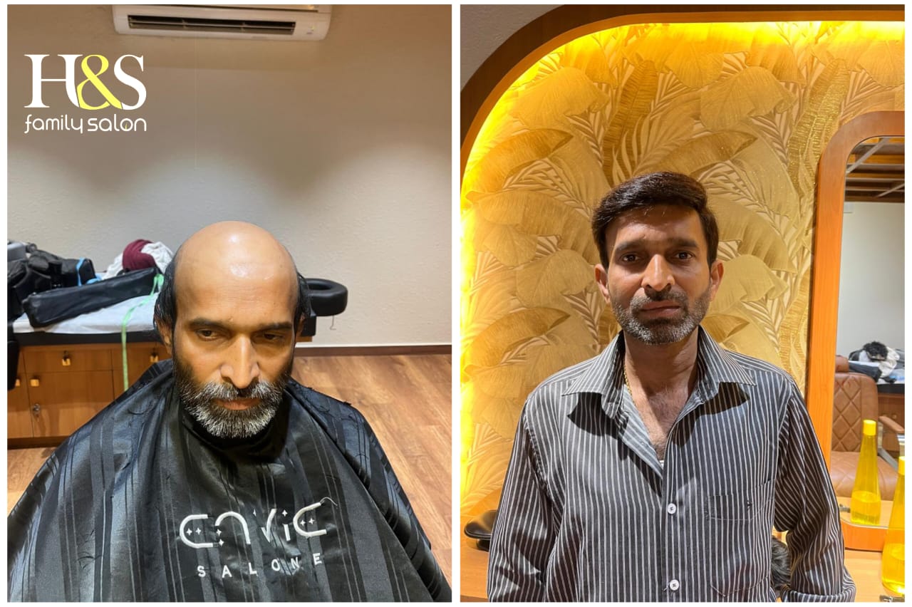 Hair Fixing in chennai