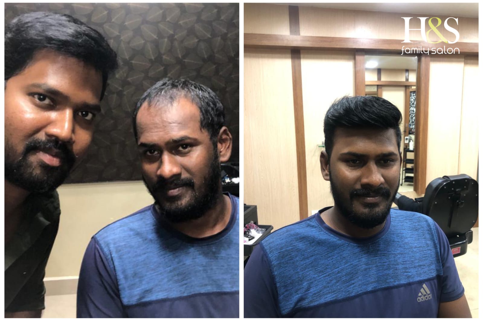 Hair Fixing in chennai
